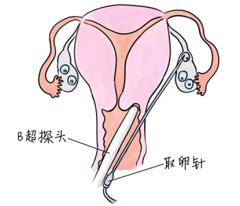 小儿退烧推拿手法 5种福州捐卵宝宝退烧按摩方法